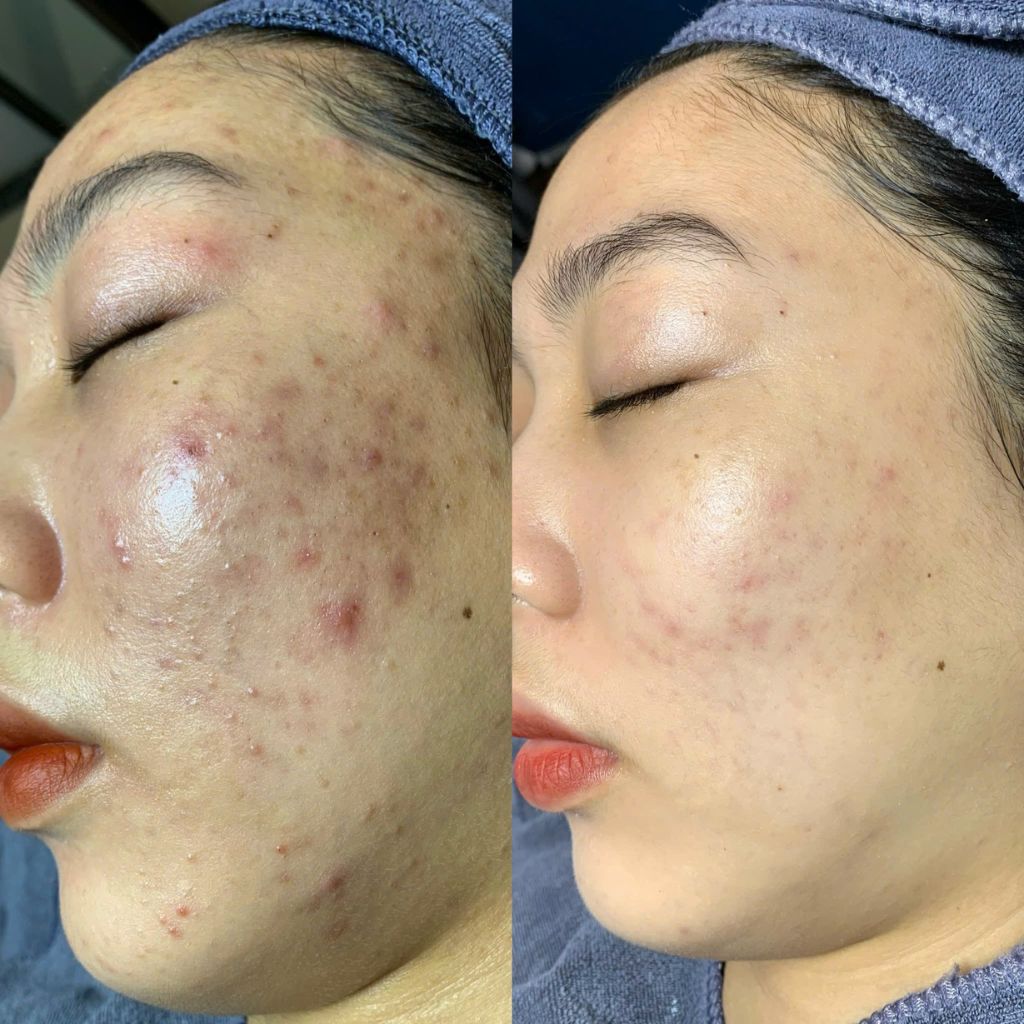 có nên peel da mặt không