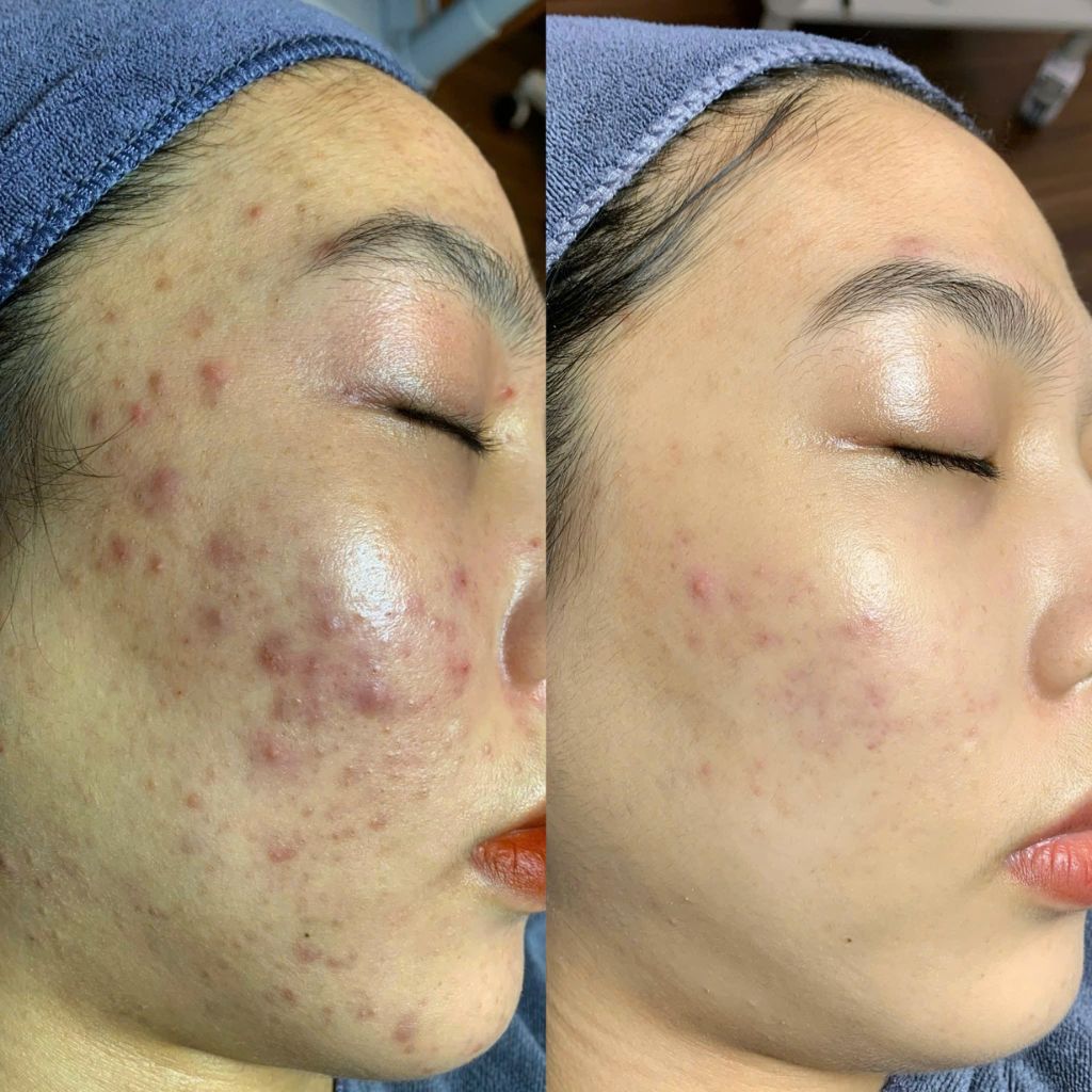 chăm sóc da sau nặn mụn