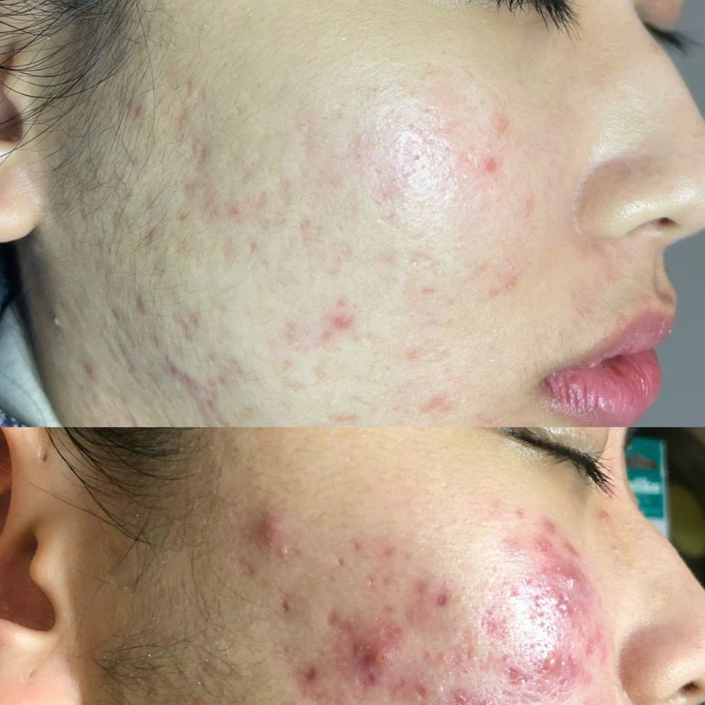 spa nặn mụn giá sinh viên